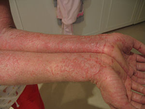 Eczema.jpg